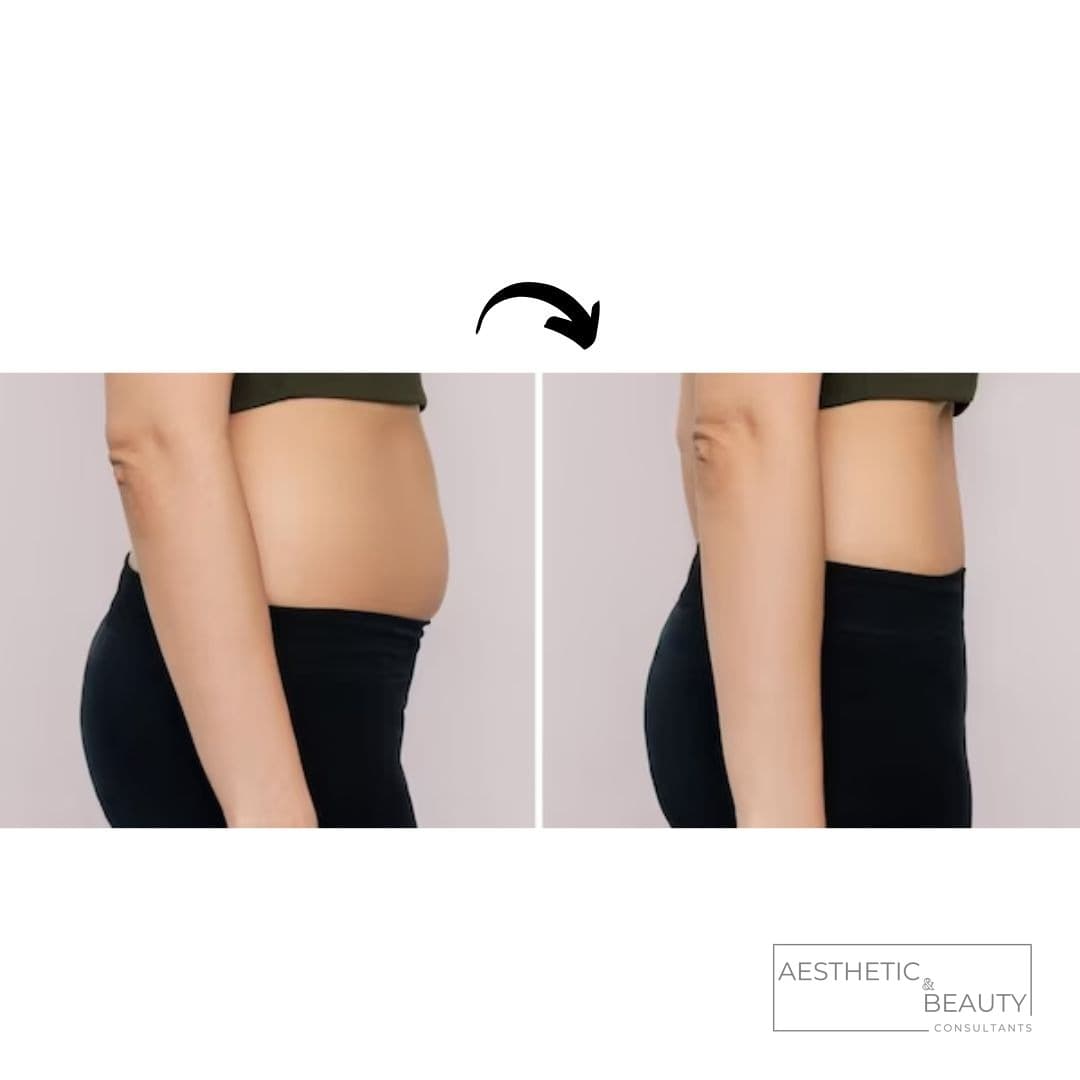 Body contouring — before and after