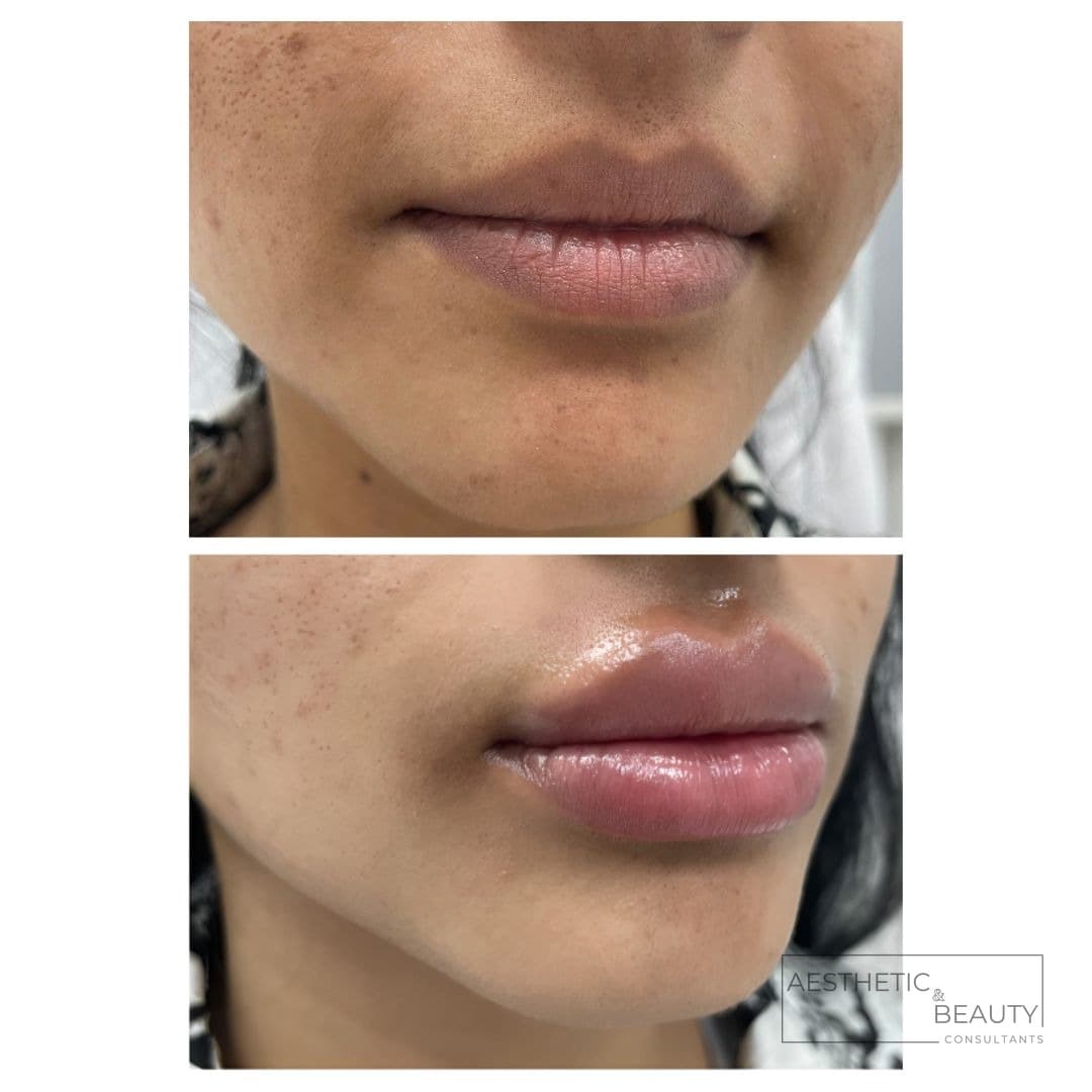 Lip enhancement — before and after