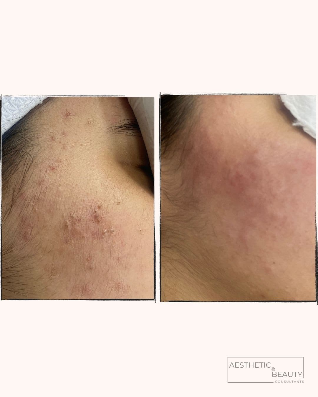 Skin rejuvenation — before and after
