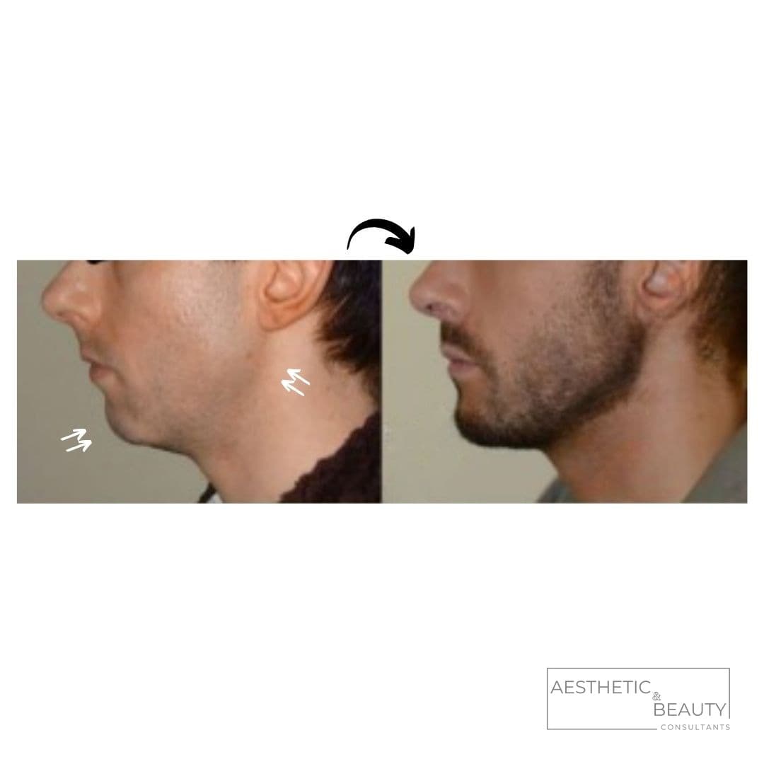 Jawline & chin — before and after