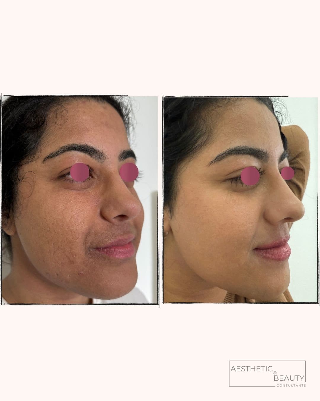 Skin & pigmentation — before and after