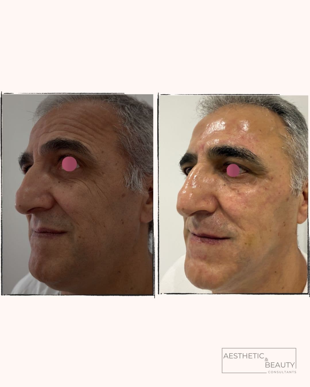 Skin rejuvenation — before and after