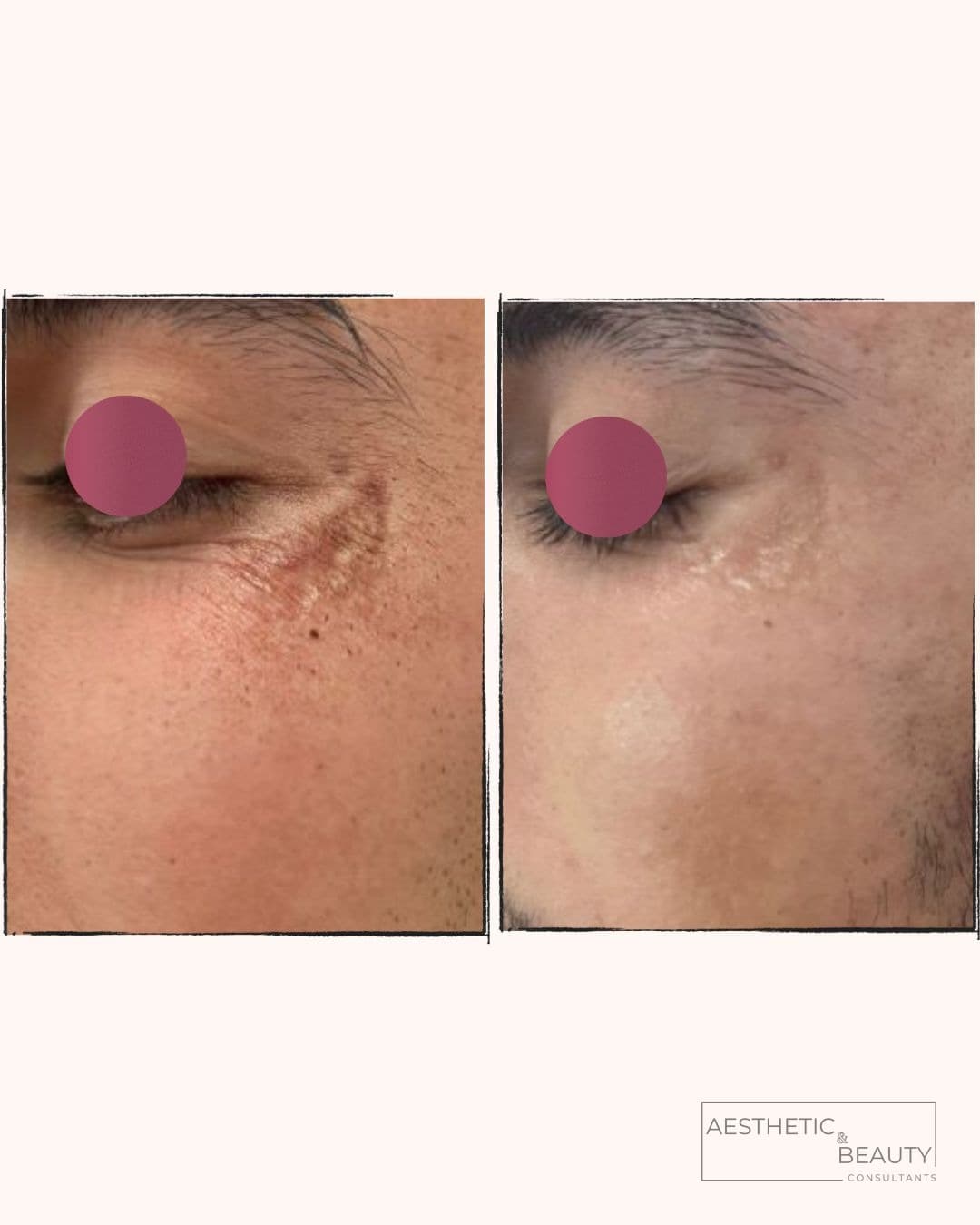 Under-eye — before and after